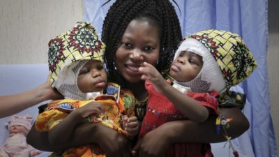 Saúde: Hospital pediátrico da Santa Sé realizou operação inédita para separar gémeas siamesas